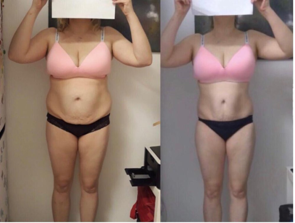 Результат клиента: коррекция фигуры с клиническим диетологом — до и после